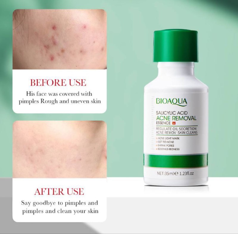 SUERO ESENCIA FACIAL PARA ELIMINAR EL ACNE CON ACIDO SALICILICO BIOAQUA 35ML